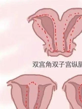 女性有染色体罗氏易位在万源市做试管养囊成功率高吗？试管移植后需要保胎吗！